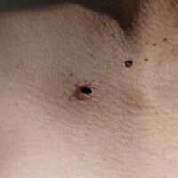 Piknik sonrası kene kontrolü uyarısı!