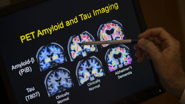 Alzheimer ilacına ilk kez tam onay!