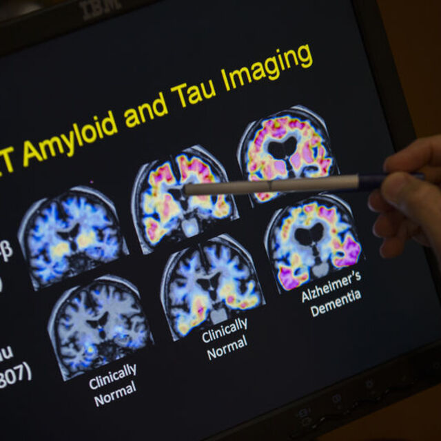 Alzheimer ilacına ilk kez tam onay!