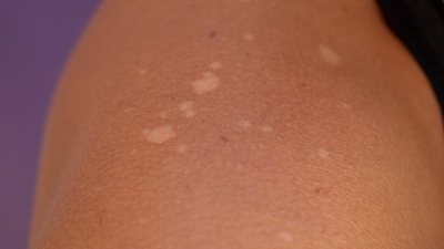 Sıcaklarda artıyor! Samyeli ile ala karıştırılmamalı