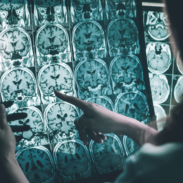 Alzheimer'ı yavaşlattığı kanıtlandı
