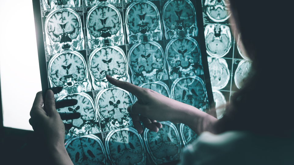 Alzheimer'ı yavaşlattığı kanıtlandı