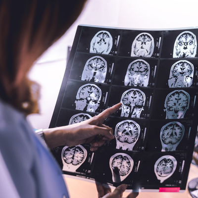 Sigara kullanımı, MS hastalığına yakalanma riskini 2,5 kat artırıyor