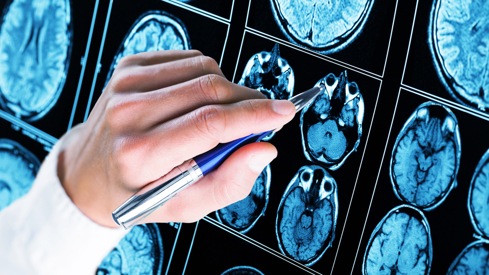 Alzheimer parmak ucundan alınan kanla teşhis edilebilecek mi?