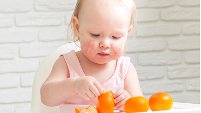 Besin alerjisi, astıma yakalanma riskini artırabilir