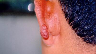 Uzmandan kan emen kum sineği uyarısı!