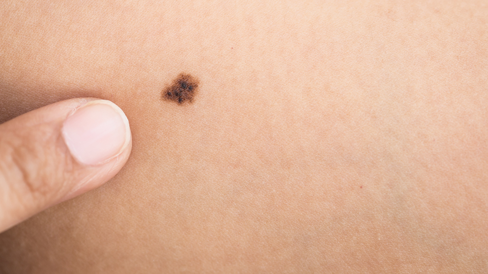 Dikkat! Kanser tanısı koyulmasını geciktiriyor