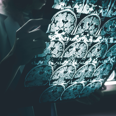 Alzheimer'da yeni risk faktörüne dikkat!