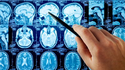 Bilim insanları açıkladı: Obeziteli bireylerin beyin şekli farklı