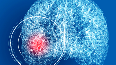 Ölümcül beyin anevrizmasıyla ilgili yeni keşif