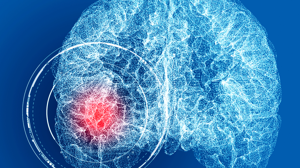 Ölümcül beyin anevrizmasıyla ilgili yeni keşif