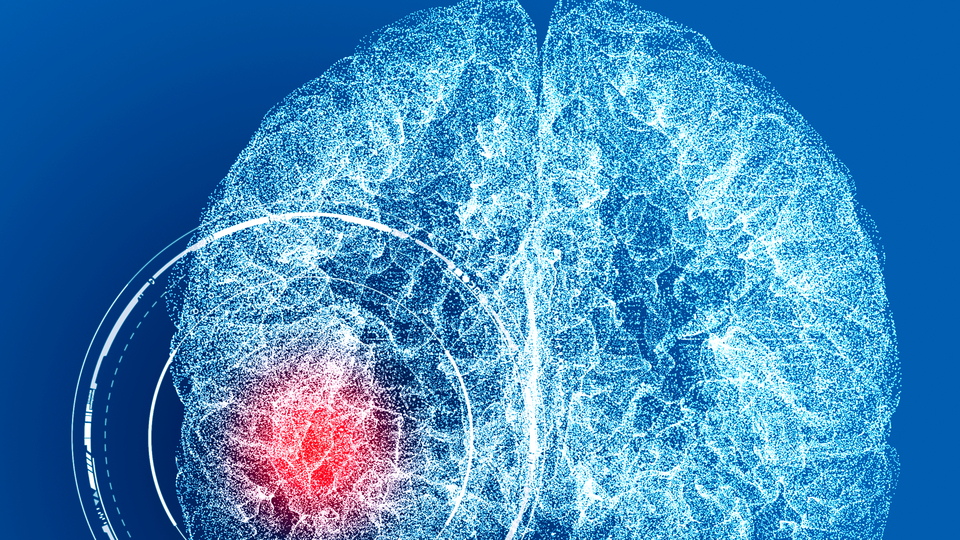 Avustralyalı kadının beyninden canlı halde solucan çıkarıldı