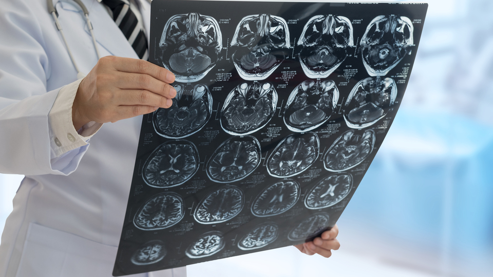 Covid-19 sonrası geçmeyen koku kaybı unutkanlık nedeni!