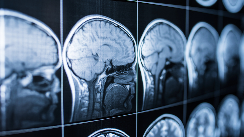 Günde 30 dakika önerisi! Alzheimer'dan koruyor!