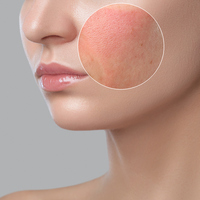 Sivilcelerin kökünü kazıyacak tedavi geliştirildi!