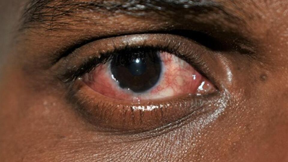 Pakistan'da kırmızı göz salgını nedeniyle okullar tatil edildi