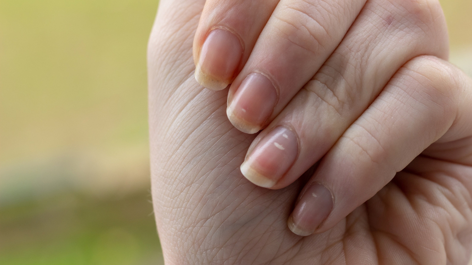 Parmak ve tırnaklardaki değişiklilere dikkat!