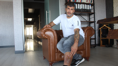 Bacağında unutulan bez parçasıyla 16 yıl yaşadı