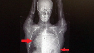 Kalbi 12 santim sağa kaydı! Dev tümör doktorları bile şaşırttı