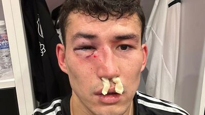 Zaynutdinov'da kırık tespit edildi!