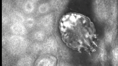 Uyuz uyarısı! "Herkes tedavi olmazsa yeniden bulaşabilir"