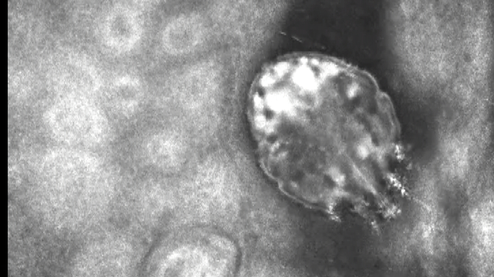 Uyuz uyarısı! "Herkes tedavi olmazsa yeniden bulaşabilir"