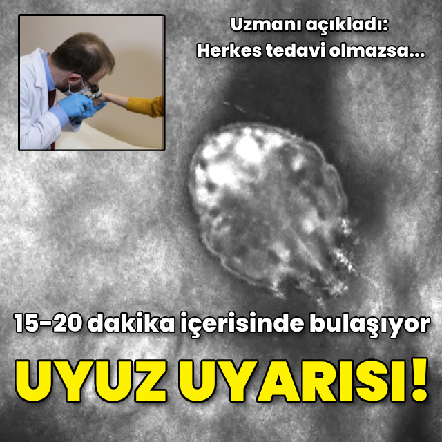 Uyuz uyarısı! "Herkes tedavi olmazsa yeniden bulaşabilir"
