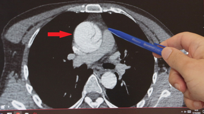 Mide ağrısı sandı, aortunda yırtık çıktı