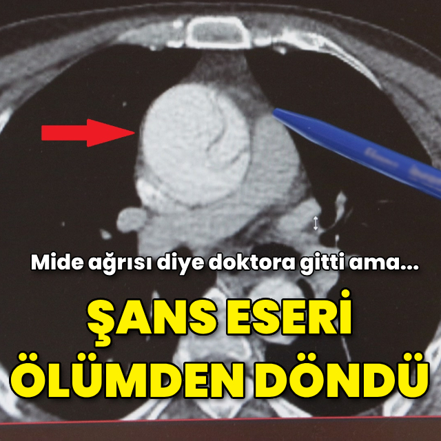Mide ağrısı sandı, aortunda yırtık çıktı