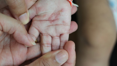 Uyuz vakalarında artış!