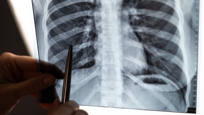 Üçlü enfeksiyon grip, RSV ve Covid-19'a dikkat!