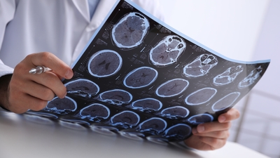 Alzheimer'ı belirti göstermediği dönemde tespit edebilen yöntem Türkiye'de