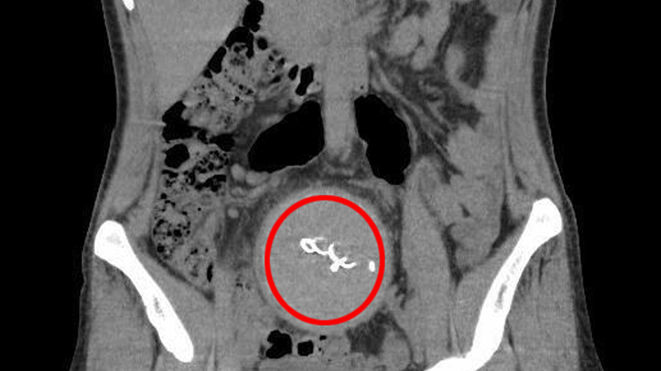 Doğumda yaşandı! Vücudunda unutulan gazlı bez, 2 yıl sonra fark edildi