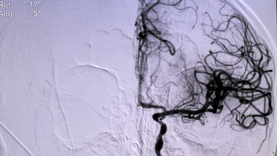 İnmeye erken müdahale ölümü ve engelliliği önlüyor