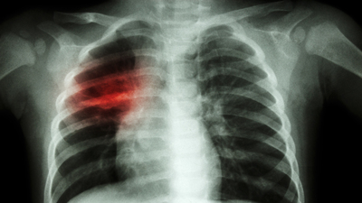 Çin'deki gizemli zatürre vakaları artıyor