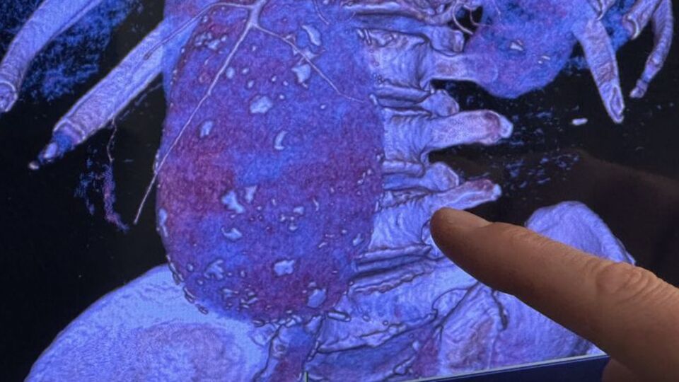 Aort damarı 11 santime çıkınca patladı!