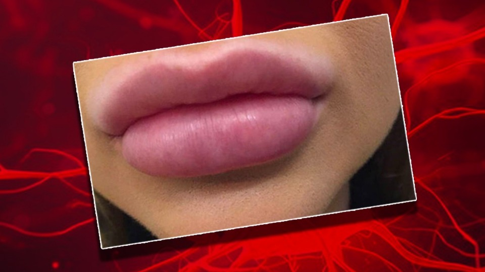 Yapılan hatalı estetik uygulamalar tedavi edilmezse 3 kişiden birinde iyileşme olmuyor