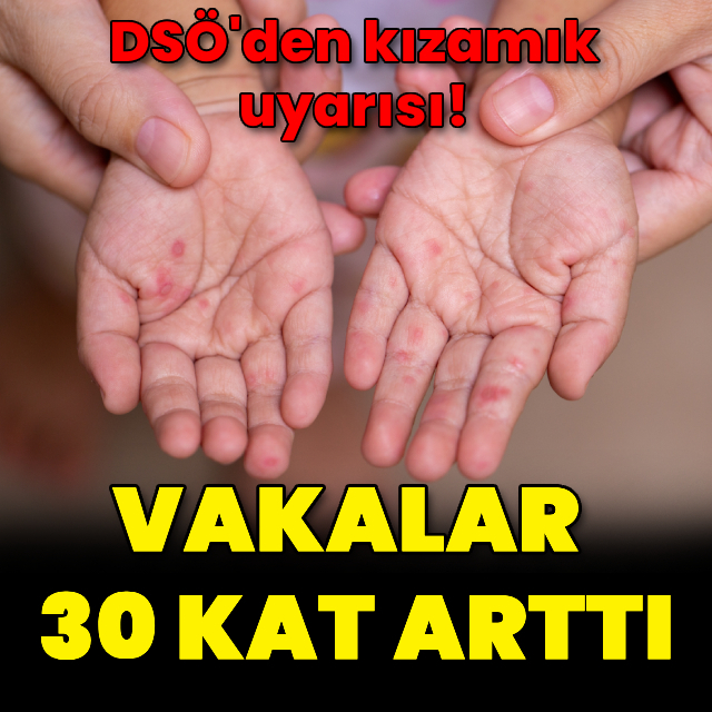 DSÖ'den kızamık uyarısı! Vakalar 30 kat arttı