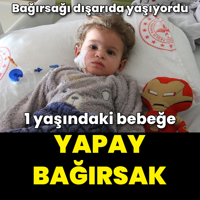 1 yaşındaki bebeğe yapay bağırsak