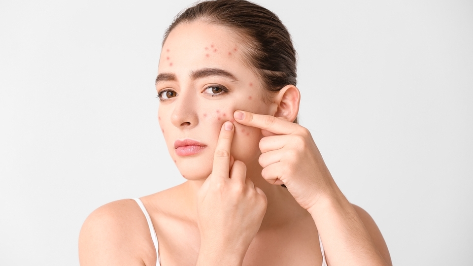 Sivilce izleri nasıl geçer?