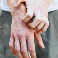 Kaşıntı neden olur?