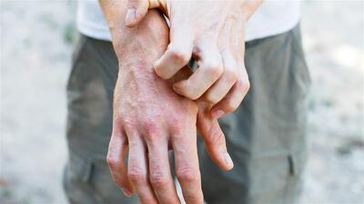 Kaşıntı neden olur?