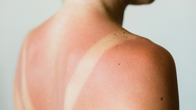 Yanığa ne iyi gelir