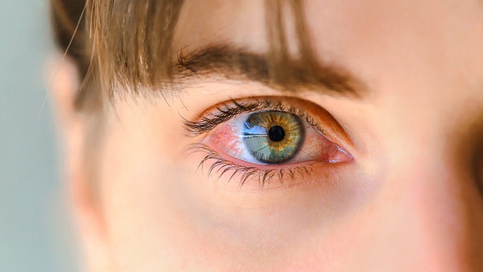 Giderek artıyor! Göz salgınına dikkat!