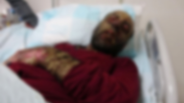 Ya�mur ormanlar�nda ya�ayanlarda g�r�len hastal�k, y�z�n� tan�nmaz hale getirdi