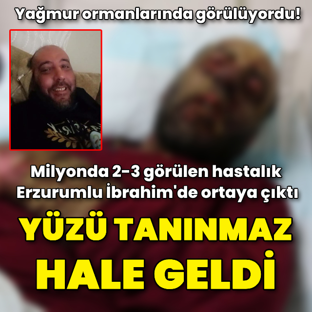 Milyonda 2-3 görülen hastalık, yüzünü tanınmaz hale getirdi
