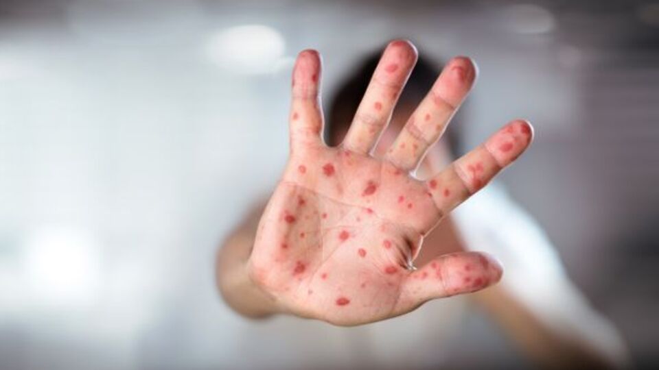 "Kızamık bir toplum sağlığı sorunu, aşı yaygınlaşmalı"