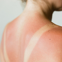 Güneş yanığına ne iyi gelir?