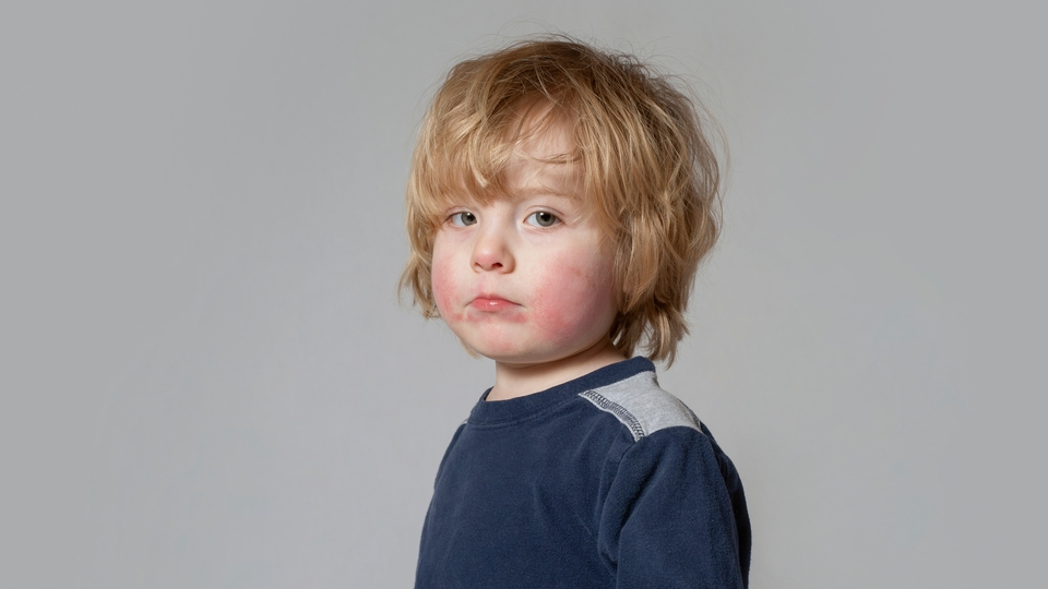 Her 100 çocuktan birinde sedef hastalığı var!