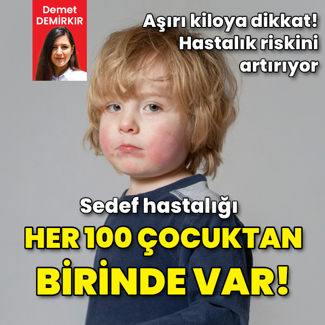 Her 100 çocuktan birinde sedef hastalığı var!